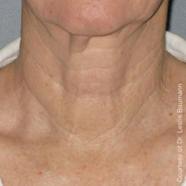 Dopo Ultherapy Prime: collo
