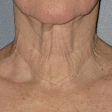 Prima di Ultherapy Prime: collo