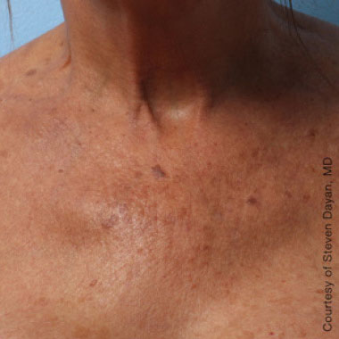 Dopo Ultherapy Prime: décolléte