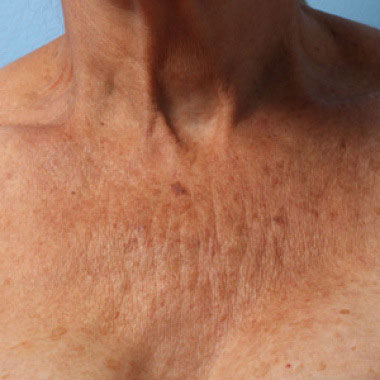 Prima di Ultherapy Prime: décolléte
