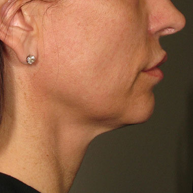 Dopo Ultherapy Prime: sottomento