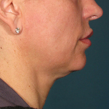 Prima di Ultherapy Prime: sottomento