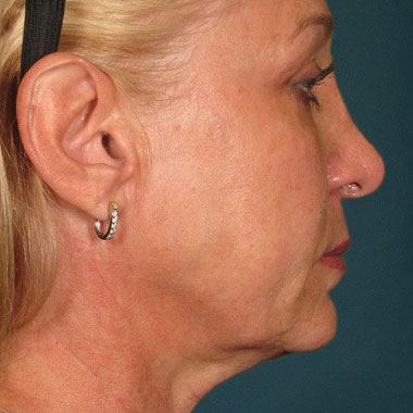Dopo Ultherapy Prime: collo
