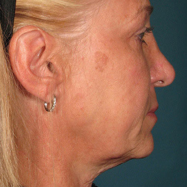 Prima di Ultherapy Prime: collo