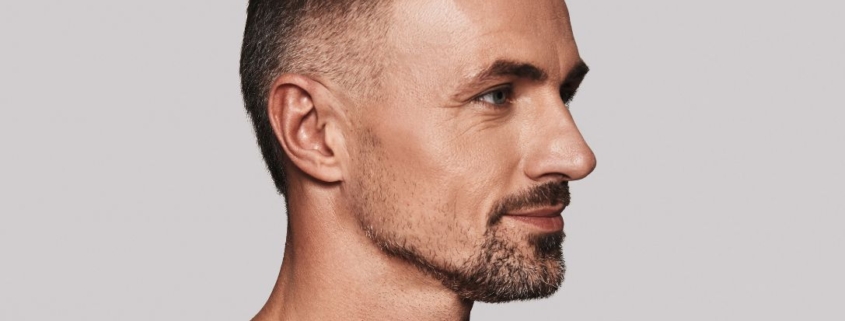 Rimodellamento jawline con ultrasuoni microfocalizzati ecoguidati