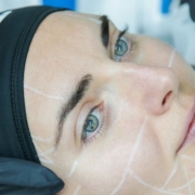 Ultrasuoni microfocalizzati ecoguidati per la pelle del viso cadente