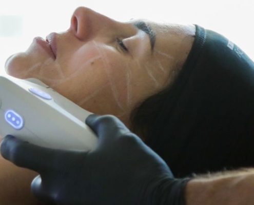 Ultherapy PRIME® come funziona il trattamento per un lifting non chirurgico